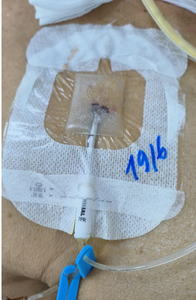 Sekali pakai steril tahan air CHG klorheksidin glukonat I.V. Pakaian aman - Product Image 5