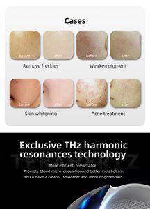 Máquina de Terapia de Belleza Indolora de Última Generación - Rejuvenecimiento de la Piel, Tratamiento del Acné y Corrección de la Pigmentación - Product Image 4