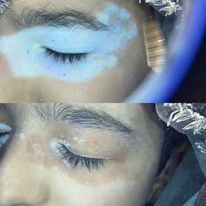 Appareil de thérapie laser excimer 308 nm pour la dermatologie, fabriqué par Kernel, 29 ans d'expérience, intensité 40 mW, traitement du vitiligo - Product Image 4