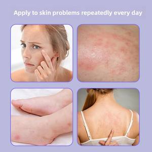 Consoude Baume Crème Anti Démangeaisons Répulsif Moustiques Piqûres Guérison <span class=keywords><strong>Apaisant</strong></span> Refroidissement Baume À Base De Plantes - Product Image 3