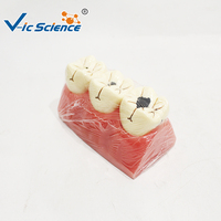 Modelo de Caries Dental de 3 Etapas, Ampliado 5 Veces, Dientes Desmontables para Educación en Patología Oral, CE ISO ROHS CNAS