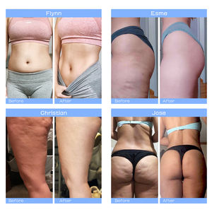 Ventosas eléctricas succión al vacío cara adelgazamiento cuerpo esculpir quema de grasa anticelulítico celulitis masajeador - Product Image 6