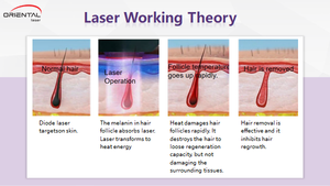 Orientalischer Laser <span class=keywords><strong>2025</strong></span> 1000w 1200w 1600w 808nm Diodenlaser griffs tück - Product Image 5