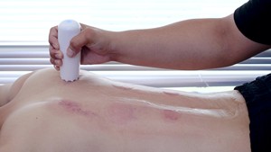 Gobelets pour thérapie hiama, lot de 3 pièces, ventouse sous vide, épais, avec pompe, <span class=keywords><strong>massage</strong></span> médical <span class=keywords><strong>traditionnel</strong></span> <span class=keywords><strong>chinois</strong></span> - Product Image 6