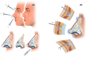 Solution de Remplissage Dermal à l'Acide Hyaluronique 2ml pour un Soutien Volumineux et un Remodelage Facial - Product Image 3