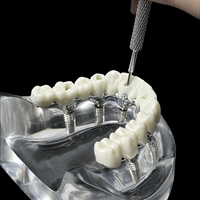 Modelo Anatómico de Implante Dental, 6 Implantes, Mandíbula Superior e Inferior, Restauración de Sobredentadura, Dientes Removibles, Educación, Estudio, Enseñanza