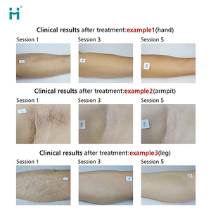 Appareil d'épilation laser diode et <span class=keywords><strong>pico</strong></span> 2-en-1 Huamei pour le retrait de tatouages et équipement de beauté - Product Image 5