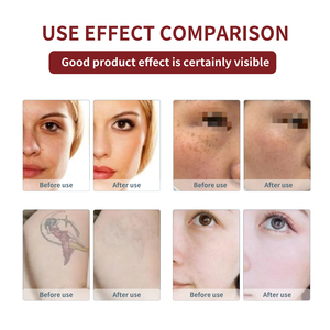 Appareil professionnel de décoloration de tatouages au laser Pico Nd-Yag à impulsions longues pour le corps, avec prises US/UK/EU - Product Image 4