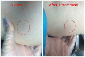 Máquina de eliminación de venas varicosas de piernas con láser 980nm máquina de tratamiento láser de venas varicosas - Product Image 6