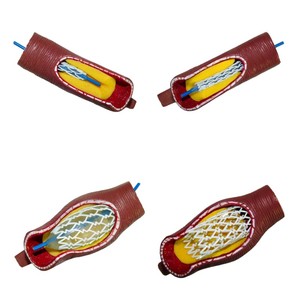 कोरोनरी हृदय रोग के लिए शैक्षिक उपकरण 4-चरण स्टेंट तैनाती प्रदर्शन मॉडल - Product Image 4