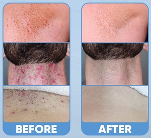 Meilleur traitement des poils incarnés, sérum anti-irritations et anti-brûlures, correcteur de taches brunes, solution éclaircissante pour la peau - Product Image 5