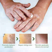 Crème Traitement du Vitiligo pour le Corps – Élimine les Taches Blanches, la Teigne, la Leucoplakie Cutanée, la Dermatite – Certifié Médical SGS Classe I