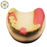 Modèle d'implant dentaire personnalisable pour la science médicale, avec dent manquante en résine, 11x10x6 cm, pour l'enseignement et la pratique