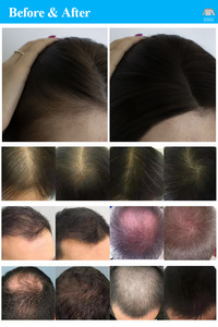 Super Deal Hair Regrowth <b>Oxygen</b> Spray Scalp Testing Hair Regrowth Ozone Electric Comb5mW <b>Machine</b> - Product Image 6