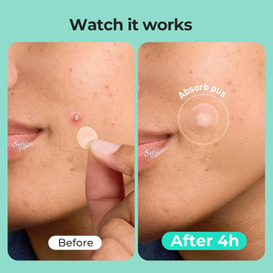 Parches para espinillas con ácido salicílico, ácido hialurónico y vitaminas, sin fragancia, para tratamiento nocturno discreto del acné en la cara, para piel normal. - Product Image 3