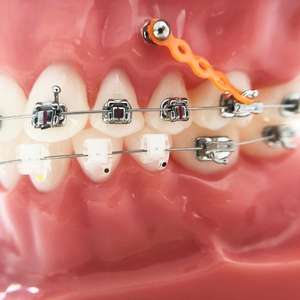 Ортодонтические стельки для зубов, 2G - Product Image 3