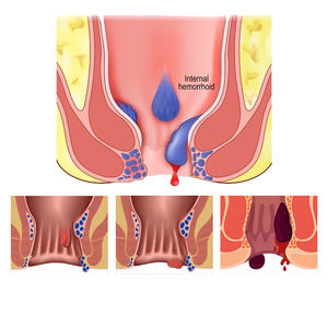 100% Natuurlijke Kruiden Lichaamsverzorgingsspray tegen Aambeien, Anale Zwelling en Pijnverlichting, 30g, CE-gecertificeerd, 2 jaar houdbaar, Gemaakt in China - Product Image 4