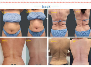 جهاز جراحة شفط الدهون الاحترافي 980 نانومتر + 1470 نانومتر جهاز إزالة الدهون بالليزر دايود شد الوجه - Product Image 6