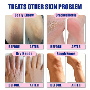 <span class=keywords><strong>Crema</strong></span> <span class=keywords><strong>per</strong></span> Ipocondensioni, Mani e <span class=keywords><strong>Piedi</strong></span> Secchi, Anti-Screpolature, Riparatrice <span class=keywords><strong>per</strong></span> Talloni Screpolati, Idratante <span class=keywords><strong>per</strong></span> Pelle Danneggiata - Product Image 4