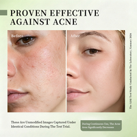 Nettoyant Visage Anti-Acné Équilibrant le Sébum, Minimisant les Pores, Éclaircissant et Atténuant les Taches Brunes, Soin Quotidien Doux Moussant