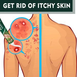 Ungüento Anti-Picazón A303, Alivia la Hinchazón y el Dolor, Repara la Piel, 20g, Extractos Herbales, Crema para la Psoriasis, 3 Años de Duración - Product Image 3