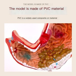 Modelo <span class=keywords><strong>de</strong></span> anatomía educativa <span class=keywords><strong>de</strong></span> Gastroenterología, sección coronal ampliada <span class=keywords><strong>de</strong></span> PVC, perforación patológica del estómago para la ciencia médica - Product Image 5