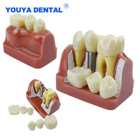 Modèle anatomique dentaire 4 fois plus grand pour implants, couronnes et bridges, en résine, pour l'analyse, la démonstration et la formation en dentisterie amovible