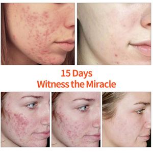 Thảo Dược mụn trứng cá kiểm soát dầu mụn kem nhanh chóng hiệu quả loại bỏ mụn trứng cá kem tại chỗ mụn loại bỏ BHA Salicylic Acid Mặt Kem - Product Image 6