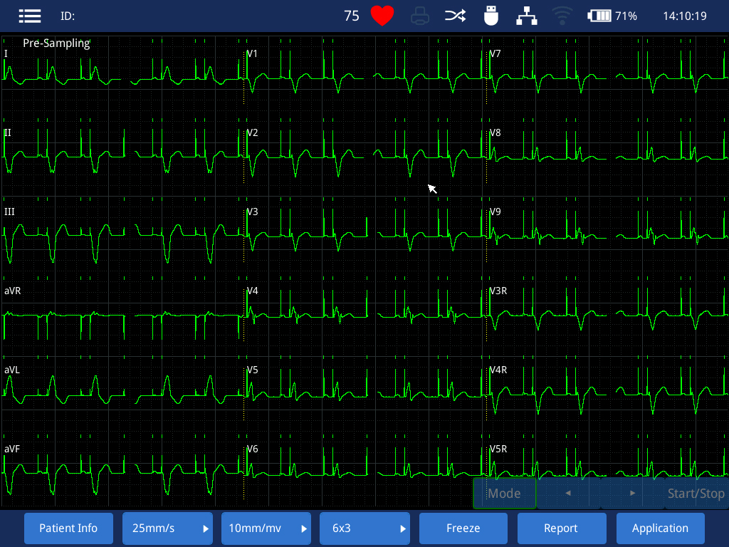 Equipo médico de alta resolución de 19 pulgadas para diagnóstico de infarto de miocardio máquina de ECG de 18 canales