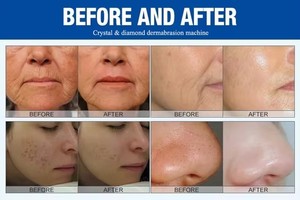 Appareil de soin du visage multifonctionnel <span class=keywords><strong>2</strong></span> en 1 pour hydrater, raffermir et éliminer les points noirs par dermabrasion - Product Image 6