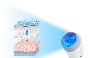 Handheld 308nm Targeted Excimer Laser Therapy 311nm Narrowband Uv Phototherapy Light Therapy Vitiligo Psoriasis - Product Image 6