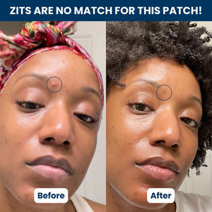 Parches de espinillas hidrocoloides veganos invisibles Derma Dot para cubrir consumibles médicos Zits - Product Image 4