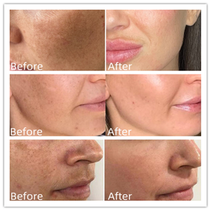 VIGOR Medical Spanish Genuine <span class=keywords><strong>Cosmelan</strong></span> <span class=keywords><strong>2</strong></span> piezas Crema para pecas <span class=keywords><strong>Mesoestetic</strong></span> <span class=keywords><strong>Cosmelan</strong></span> Adecuado para todo tipo de piel, solo clínica en el hogar - Product Image 3