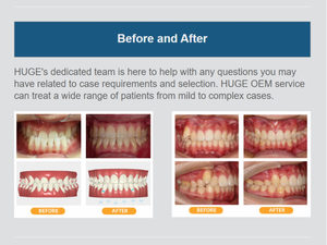 Alineadores Dentales Transparentes Manuales Premium VinciSmile para Enderezar los Dientes, Tamaño Grande, Certificación CE - Product Image 4
