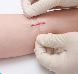 Kit de Suturas de Cierre Rápido Longmed, Dispositivo Desechable para Cierre de Heridas, Certificación CE Clase I, Desinfección con Ozono - Product Image 3