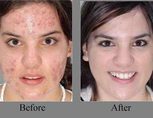 Productos para el cuidado de la piel a granel de fábrica para el tratamiento del removedor del acné Suero Anti Acné Parche de espinillas Acné para el cuidado facial de las espinillas - Product Image 2