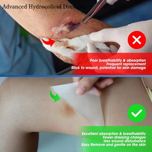 Hysent China fabricante médico Healqu hidrocoloide autoadhesivo hidrocoloide apósitos para heridas para <span class=keywords><strong>ampollas</strong></span> callos - Product Image 5