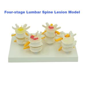 Lesione della colonna lombare a quattro stadi modello anatomico per l'educazione medica - Product Image 3