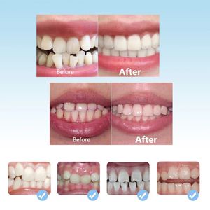 Aparatos de Ortodoncia de 3 Etapas para Enderezar los Dientes, <span class=keywords><strong>Brackets</strong></span> Dentales Invisibles, Bandeja Bucal de Ortodoncia, <span class=keywords><strong>Alineadores</strong></span> de Dientes - Product Image 3