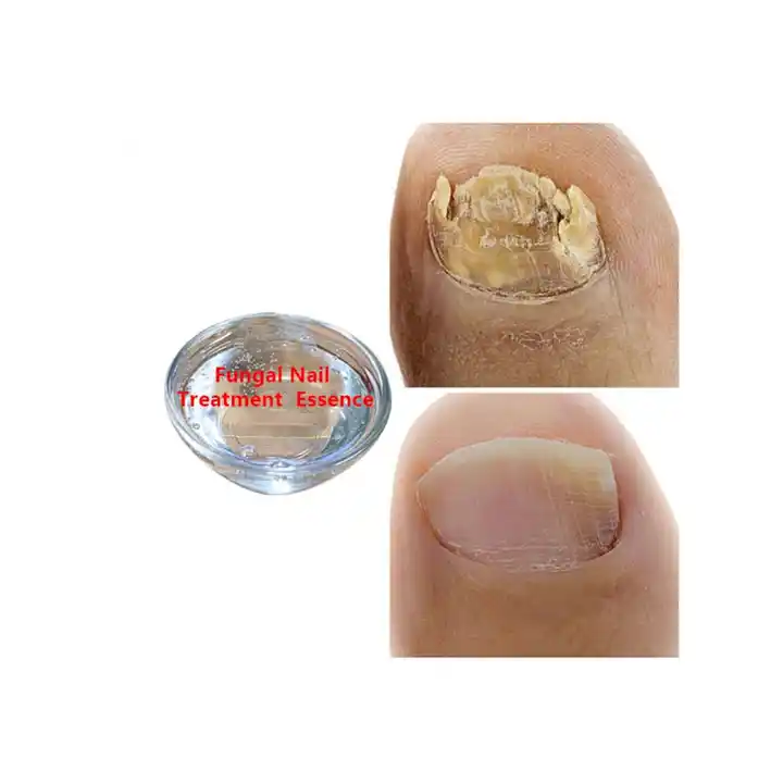 Paronychia Swollen Finger Fingernail Bed Inflammation Stock Photo  1435608734 | Shutterstock