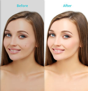 YOUMAY stylo de beauté rechargeable sans fil dissolvant d'étiquette de peau stylo de suppression de taupe affichage LCD tache gomme - Product Image 2