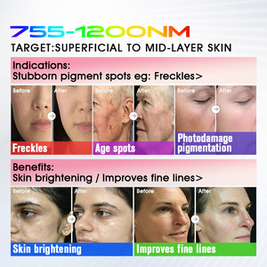 Appareil de photothérapie BBL à large bande, très populaire, efficace pour l'élimination des taches de rousseur et des taches solaires, et l'éclaircissement de la peau - Product Image 4