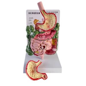 Un modèle de pathologie du système digestif humain dans le gros intestin - Product Image 2