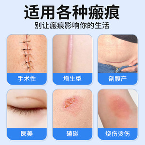 Medical Scar Patches Silicone Gel Skin Color Repair Tape For Scar Fading With Approval Number Zhejiang 20142140150 - Product Image 4