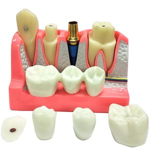 Modèle d'implant dentaire 4-en-1 avec couronne amovible, pont dentaire et facettes en porcelaine pour l'étude et la démonstration pédagogique - Product Image 1