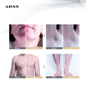 ADSS 808nm diodo Laser dispositivo di bellezza Lazer depilazione macchina elettronica medicina estetica professionale - Product Image 5