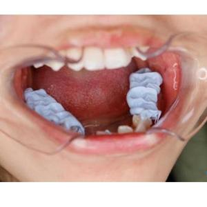 Registrazione del morso di Chemoment-prodotti della clinica dentale - Product Image 1