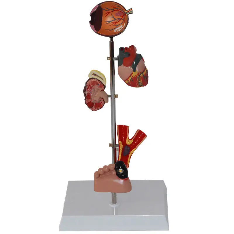 Mini Diabetes tipo 2, modelo de órgano anatomico, ojo, corazón, riñón, Arara, pie