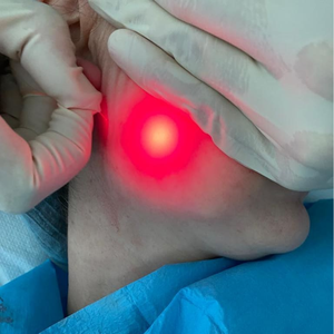 SMA905 interfaz estándar radial/cónico/fibras desnudas cirugía médica fibras láser para lipólisis EVLT cirugía de hemorroides - Product Image 6