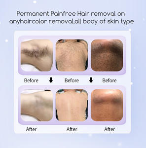 10% de réduction, prix avantageux, machine d'épilation au laser diode à 3 longueurs d'onde, 4 ondes, platine, titane, 755nm, 808nm, 1064nm, neuve - Product Image 5